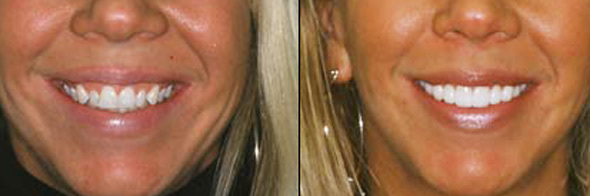 how much do veneers cost